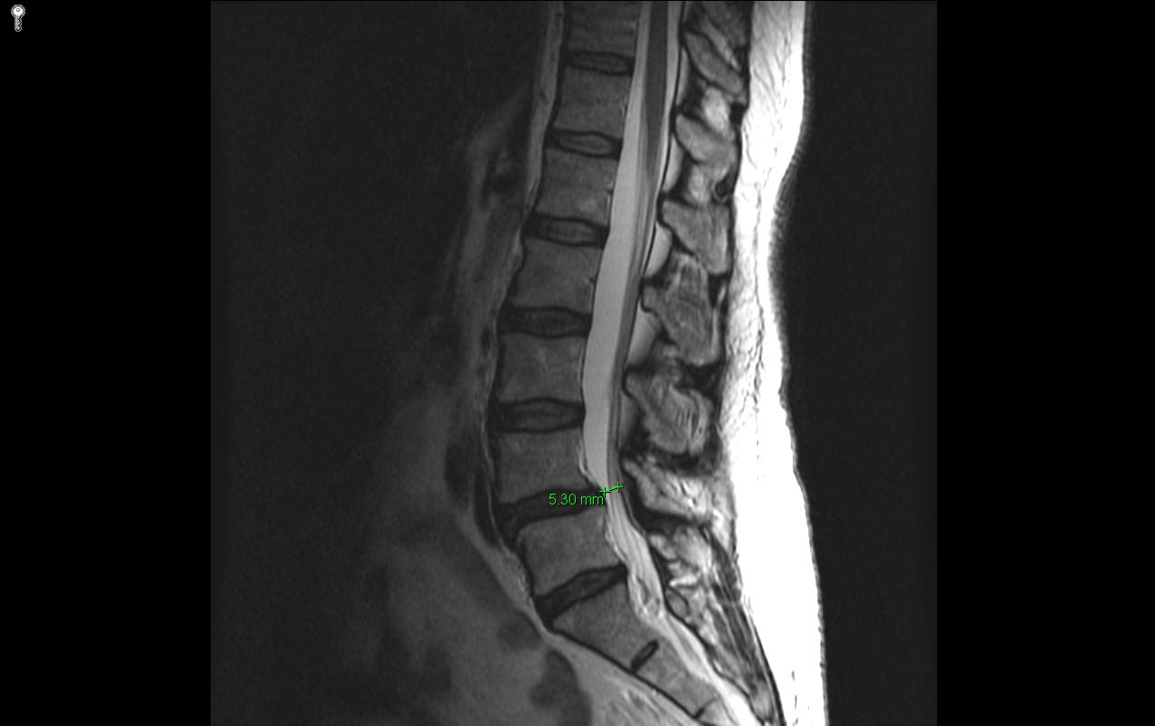 Lumbar Spinal Stenosis – John Snyder, DPT